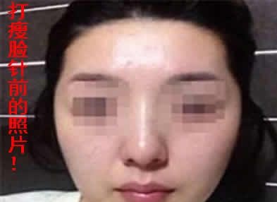公开我在运城华美整形花999元打瘦脸前后对比照片及一年后真实感受