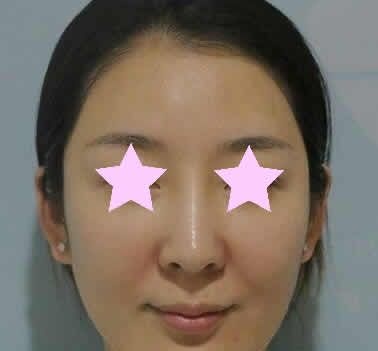 透露一下我在聊城韩美整形做全脸线雕提升前后对比照片和亲身经历