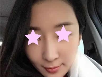 透露一下我在聊城韩美整形做全脸线雕提升前后对比照片和亲身经历 图2