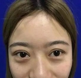 喜欢欧美范的小仙女可以参考我找邯郸丽人陈逸华医生做的假体隆鼻案例