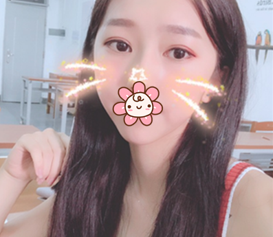 老妈夸我在乐山达芬奇做的埋线平行双眼皮显得眼睛大好看 案例图2