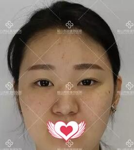 鞍山注射隆鼻哪家好?看我在鞍山齐敏整形医院做玻尿酸隆鼻+隆下巴术后15天效果图!