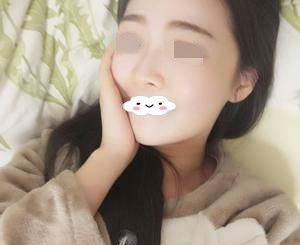 我在邵阳德美找李倩院长做了激光去红血丝,分享一下术后半个月的效果 图2