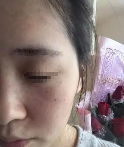 皮秒祛斑和大Q祛斑一样吗?看遗传麻子脸在泰州华美做大Q祛雀斑术后无后遗症效果还不错