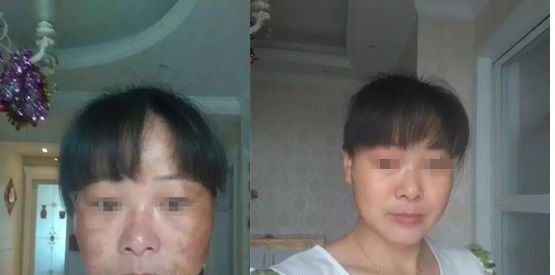 宜春祛斑哪家强?来围观这有两位深受斑点困扰的求美者的祛斑经历 图2