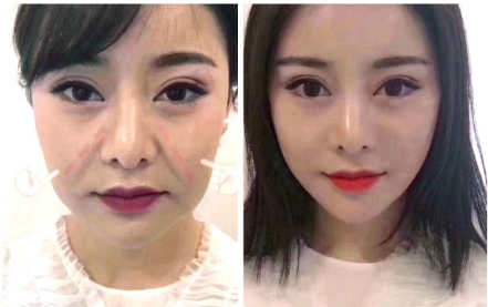 想做线雕但是纠结不知道选泰州丽都还是华美的你,先来看看丽都给出的几组前后对比照 图2