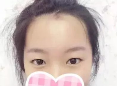 在玉林华美做双眼皮手术20天后改善了我的肿眼泡单眼皮
