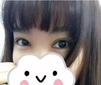 在玉林华美做双眼皮手术20天后改善了我的肿眼泡单眼皮 图2