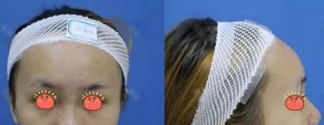 看一下我找桂林华美做了鼻综合手术3个月的效果你就知道院长技术怎么样