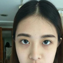 为了年底的相亲,在威海做了自体脂肪填充全脸面部手术,大功告成了