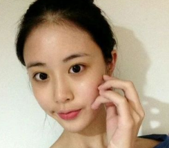 为了年底的相亲,在威海做了自体脂肪填充全脸面部手术,大功告成了 图2