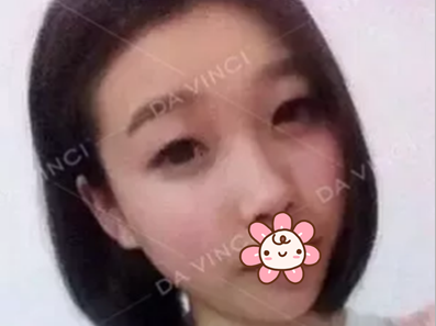 内江达芬奇切开双眼皮开眼角术后3个月恢复过程图片公开