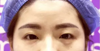 听说怀化德美整形符恒做双眼皮很厉害，于是我找他做了显微精雕电眼术，效果真没让我失望！