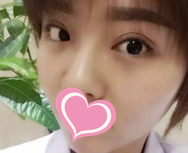 听说怀化德美整形符恒做双眼皮很厉害,于是我找他做了显微精雕电眼术,效果真没让我失望! 图2