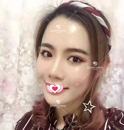 我从憔悴暗淡的土妞到元气满满的网红脸 全靠保定蓝山的脂肪填充面部手术 案例图2