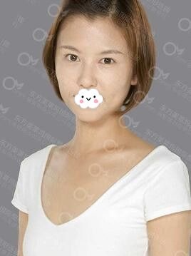 阜阳隆胸哪家好?阜阳东方美莱坞医疗美容医院勇中华假体隆胸真人案例