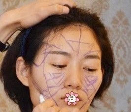 哦我把去贵阳华美整形美容医院面诊时要到的自体脂肪全脸填充价格和手术经历说给你听听。