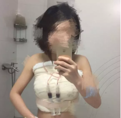青岛华韩做假体隆胸手术挺好的,分享青岛华韩真人隆胸日记给你参考 图2
