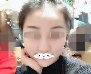 终于预约到了蒋松林院长做了精雕仿生隆鼻,给你们看下我术后半个月的效果吧