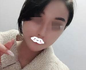 终于预约到了蒋松林院长做了精雕仿生隆鼻,给你们看下我术后半个月的效果吧 图2