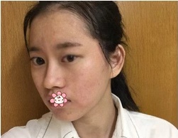 面诊沟通时贵阳甲秀整形的医生王靖说我的大小眼单眼皮割个全切双眼皮就好啦 果然!