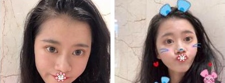 面诊沟通时贵阳甲秀整形的医生王靖说我的大小眼单眼皮割个全切双眼皮就好啦 果然! 图2