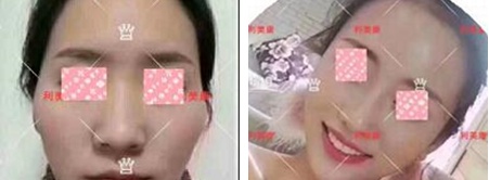 遵义利美康打玻尿酸效果怎么样?玻尿酸丰苹果肌太阳穴等案例展示