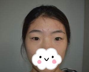 只是在株洲华美年华做了个切开双眼皮+开内眼角,没想到就发生了这么大的变化