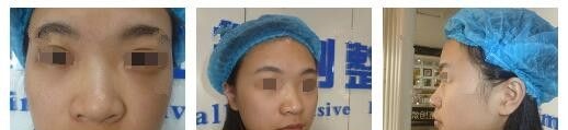 面诊过连云港华美后找了孙振东医生做了硅胶鼻综合，术后一个月超自然不怕揉捏