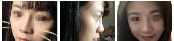 面诊过连云港华美后找了孙振东医生做了硅胶鼻综合,术后一个月超自然不怕揉捏 图2