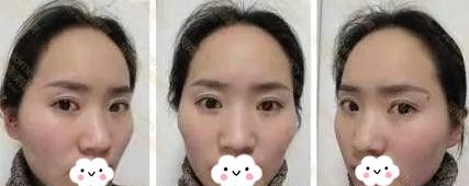 信阳做面部脂肪填充哪家医院好?看看我在易韩找张鹤明院长填充的心形脸效果就知道