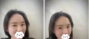信阳做面部脂肪填充哪家医院好?看看我在易韩找张鹤明院长填充的心形脸效果就知道 图2