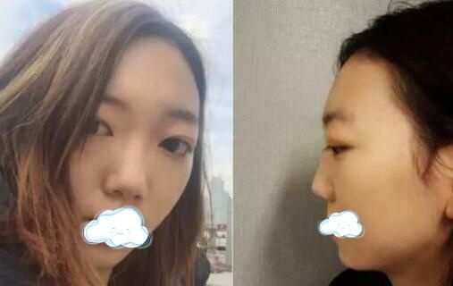 做过隆鼻的朋友看了我在广安华美悦美做的鼻综合手术效果竟然想去做修复