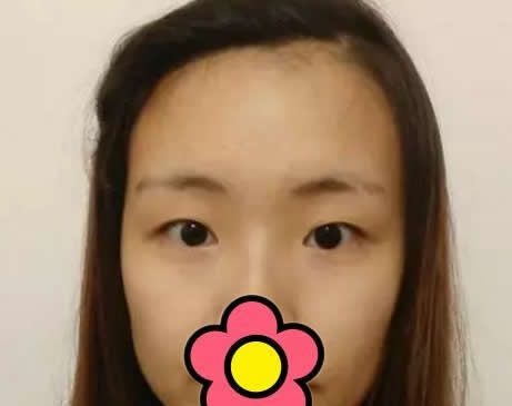 看了我在赤峰夏天整形割双眼皮+开眼角一个月的效果后 朋友都说这样的价格太值了