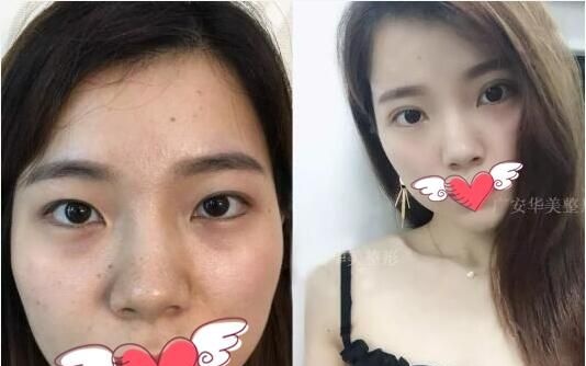 分享三例广安华美悦美整形美容医院双眼皮开眼角整形手术案例
