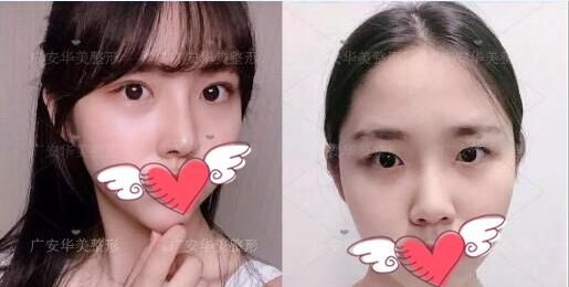 分享三例广安华美悦美整形美容医院双眼皮开眼角整形手术案例 图2