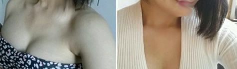 透露我在桂林时光整形做曼托275cc假体隆胸62天恢复实况,胸部从A直接到C 图2