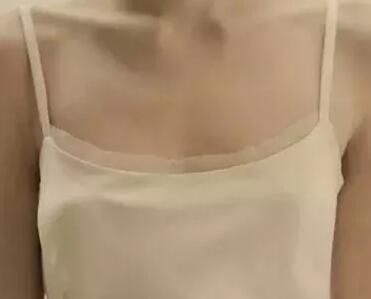 分享找扬州美贝尔做美国曼托水滴形假体隆胸案例，从腋窝下放入术后两月就完全恢复了