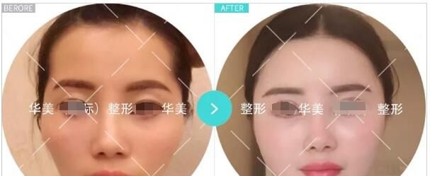 淮安华美高学龙医生分享多个案例:SAC超活自体脂肪细胞填充不只是丰胸还能改善面部衰老