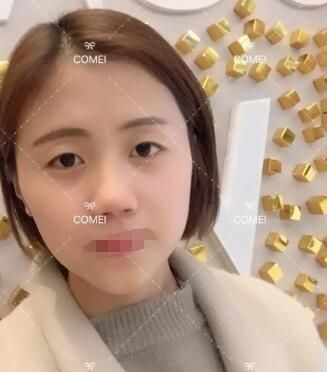 到南通康美一下子做了切开双眼皮+硅胶隆鼻+假体垫下巴迎来立体精致的五官