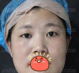 人生初次整形我选择金华永康光大医院郭院长做了6mm全切开扇形双眼皮和开内眼角