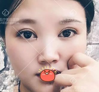人生初次整形我选择金华永康光大医院郭院长做了6mm全切开扇形双眼皮和开内眼角 图2