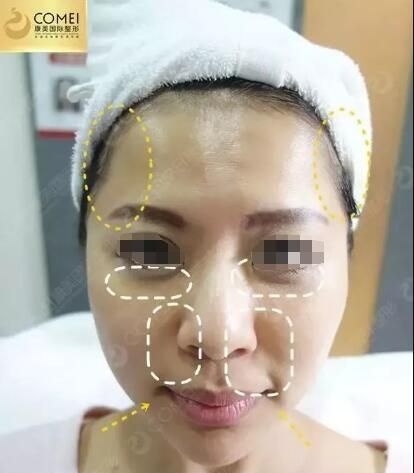 趁着伊婉玻尿酸有优惠价格到南通康美填充改善法令纹凹陷泪沟还顺带给下巴也注射了一支