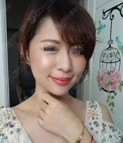 趁着伊婉玻尿酸有优惠价格到南通康美填充改善法令纹凹陷泪沟还顺带给下巴也注射了一支 图2