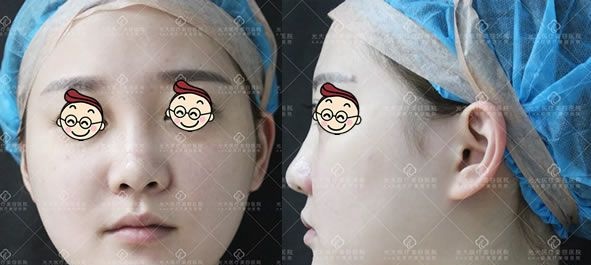 好嗨哟,2018年7月29日在永康光大整形做了鼻综合隆鼻和V脸术后感觉人生已经到达了巅峰