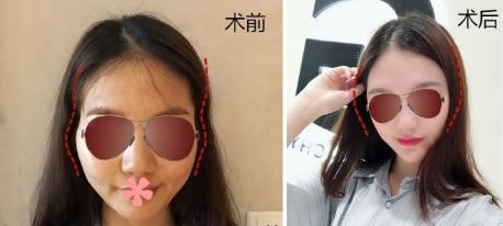 我担心自体脂肪填充反而变丑,没想到我这次去厦门薇格做完自体脂肪填充全脸的效果还不错 案例图2
