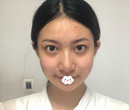 荆州隆鼻失败修复哪家医院整形效果好?找荆州华美李杰做鼻综合修复歪鼻