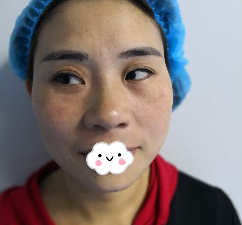 花1W多价格在荆州华美做自体脂肪面部填充30天恢复效果照片在这里