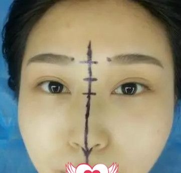 在秦皇岛巧致做完硅胶隆鼻术后1个月 终于拥有我梦寐以求的高挺俏丽自然鼻