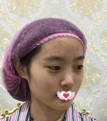 都说我找秦皇岛纪辉韦杰医生做硅胶隆鼻手术效果自然立体 你们觉得怎么样